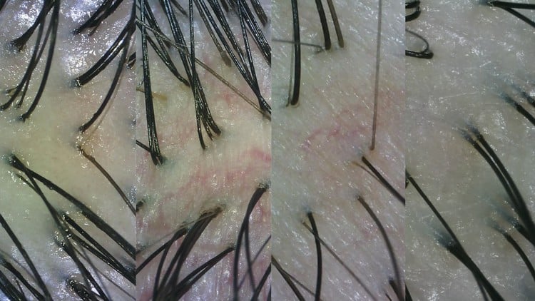 آموزش تشخیص نوع پوست سر

