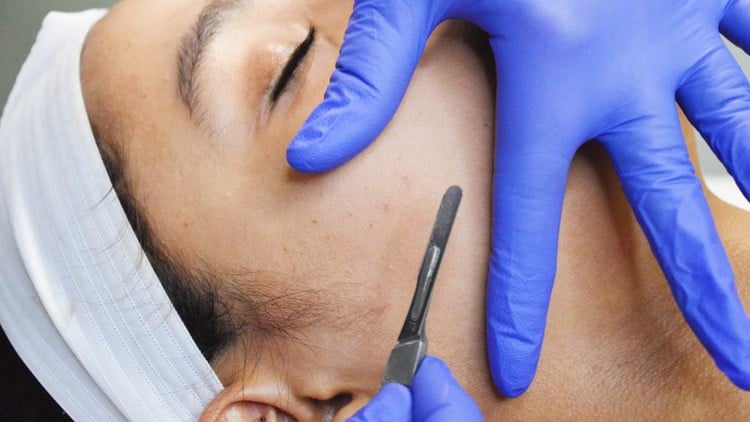 آموزش راهنمای جامع انجام فشیال درماپلنینگ

