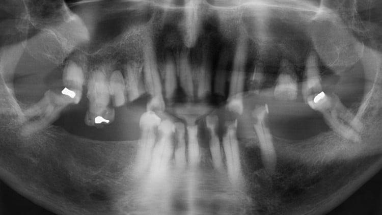 آموزش کشیدن دندان مدرن - سریع، بدون درد، و غیرتهاجمی
