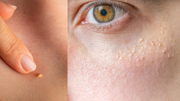 آموزش پاک کردن پیلاریوما و میلیوم با قلم پلاسما
