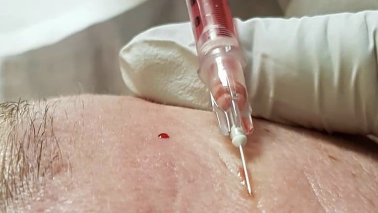 آموزش دوره تخصصی فیشیال خون آشام (پلاسمای غنی از پلاکت) سطح 4 - مدرک معتبر

