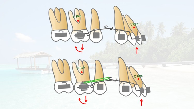 آموزش درمان ارتودنسی در رویش دندان های دائمی اولیه


